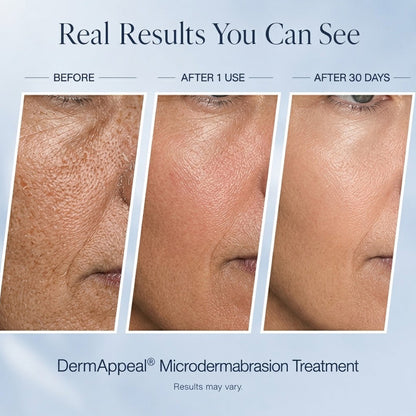 Microdermabrasion Treatment w/ V5 Crystal Technology Facial Exfoliate