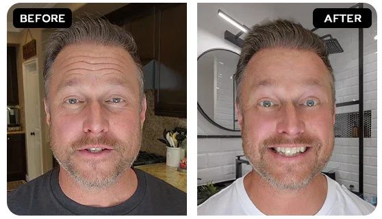 Deep Wrinkles & Lines before and after
