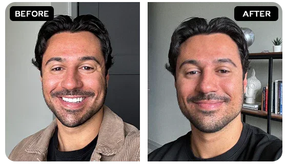 Sagging Jawline & Jowls before and after