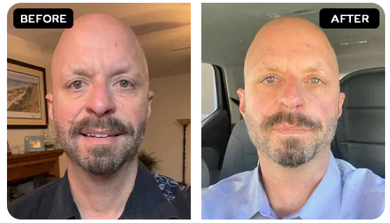Eye Bags & Dark Circles before and after