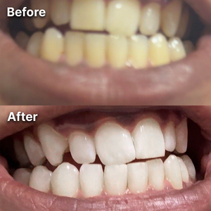 Before and after teeth whitening result