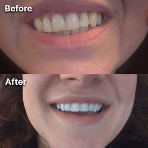 Before and after teeth whitening result