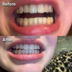 Before and after teeth whitening result