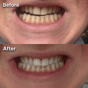 Before and after teeth whitening result