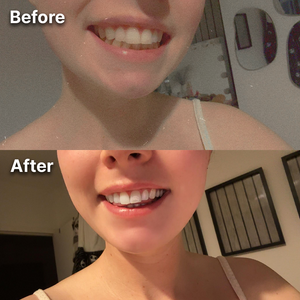 Before and after teeth whitening result