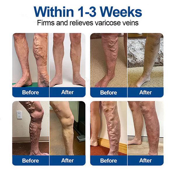 🇬🇧👨‍⚕️✅VeinTarget Microneedle Patch⚡Instant Relief, Long-Term Results