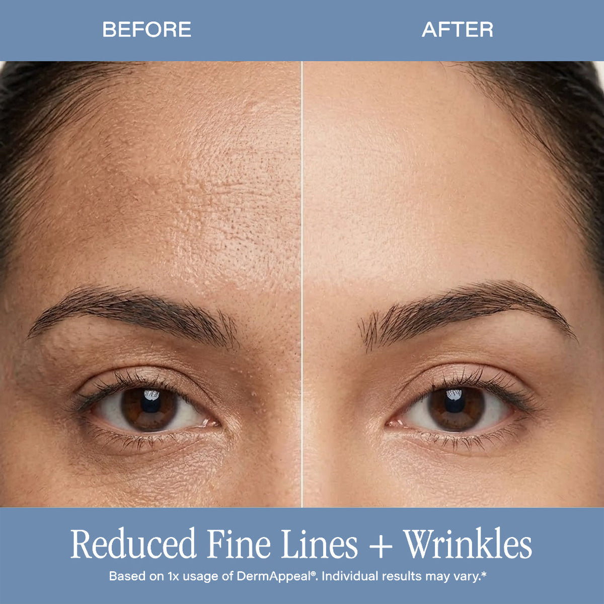 Microdermabrasion Treatment w/ V5 Crystal Technology Facial Exfoliate