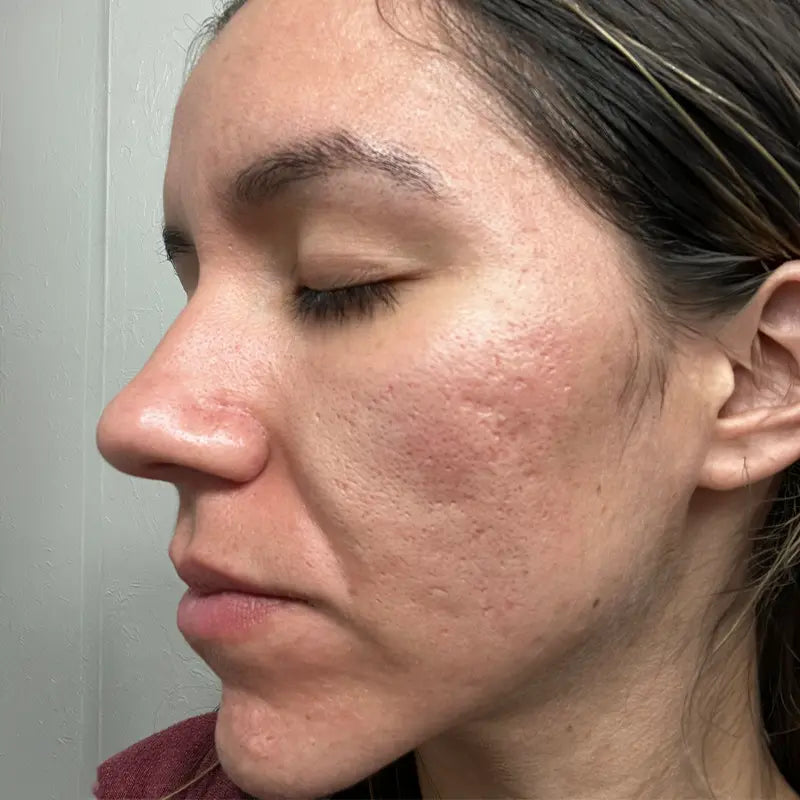 Skin after four to six weeks