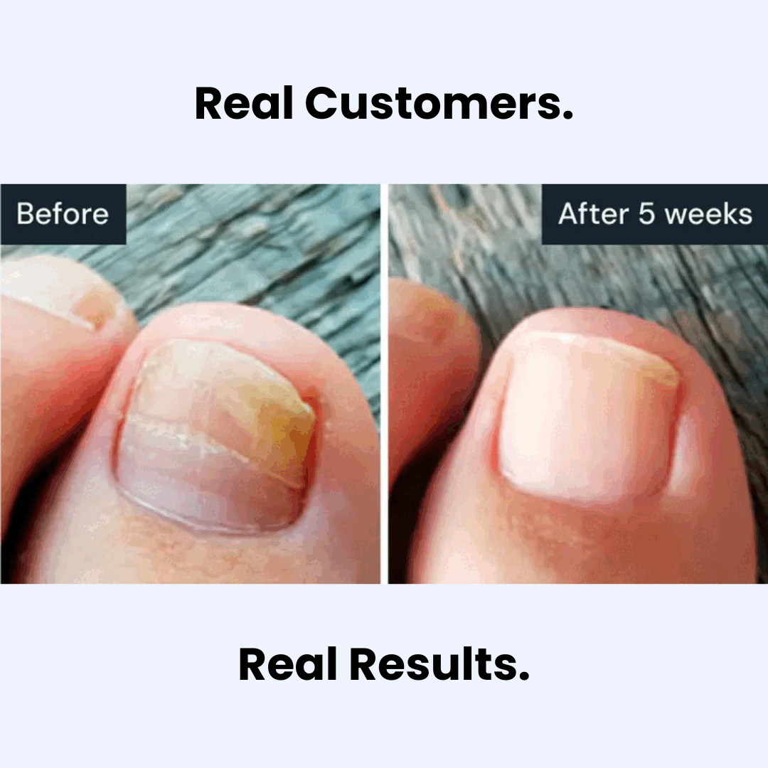 Nailtouch Antifungal Pen