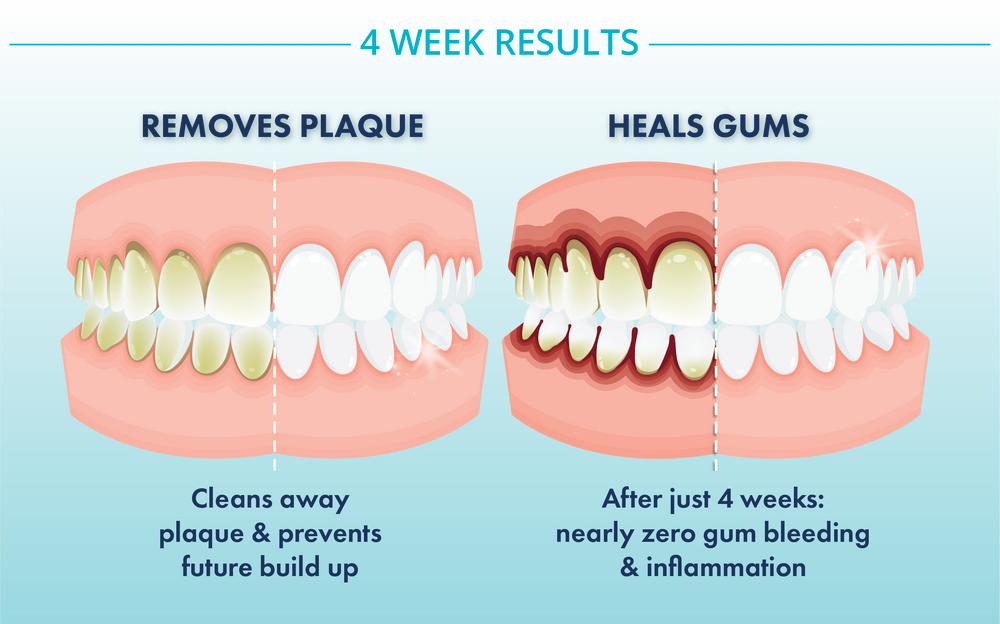 four_week_results_plaque_gums.png