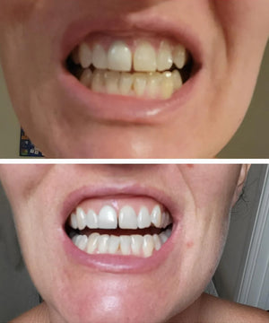 Customer teeth whitening result